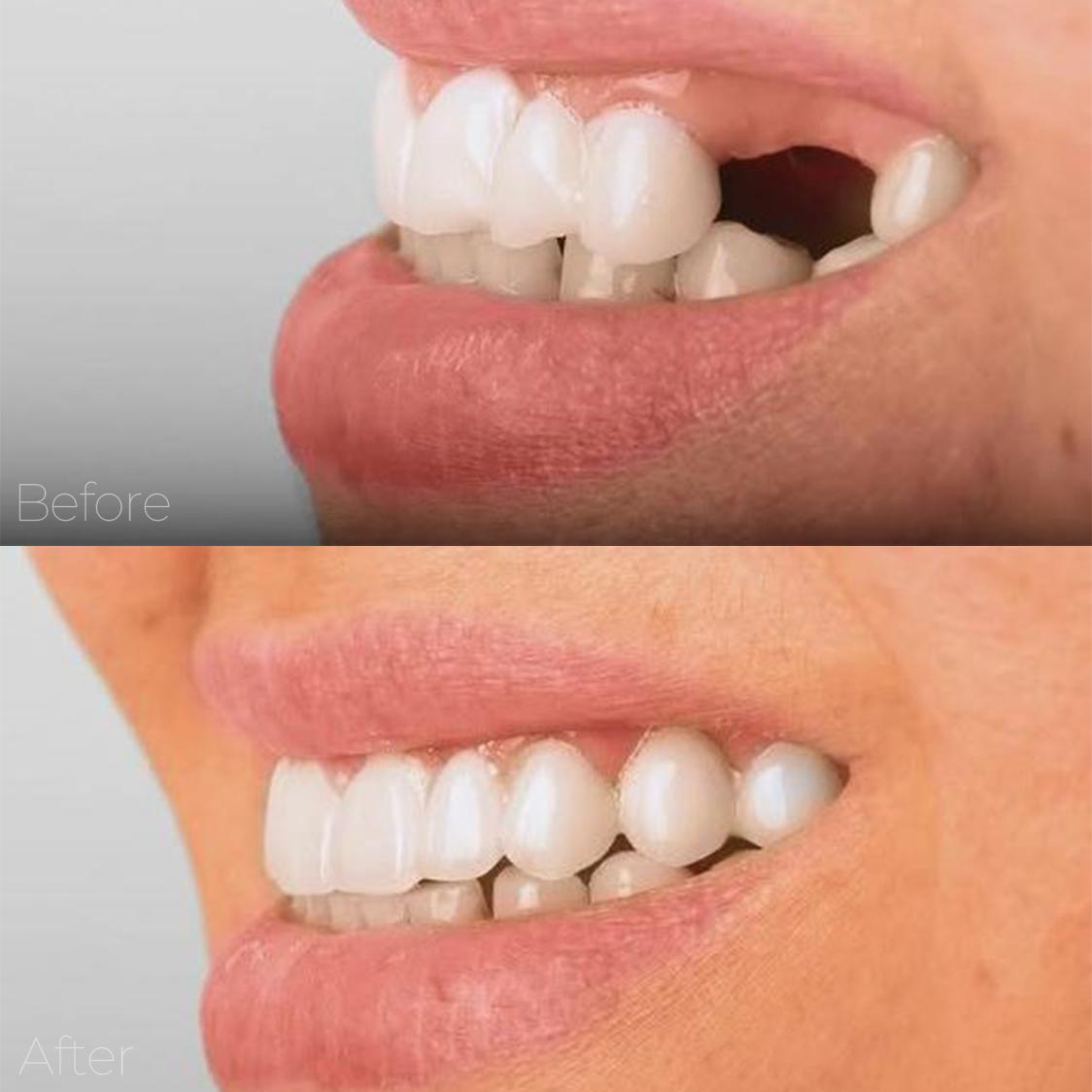 حالة تجميل أسنان - تركيبات الزيركون