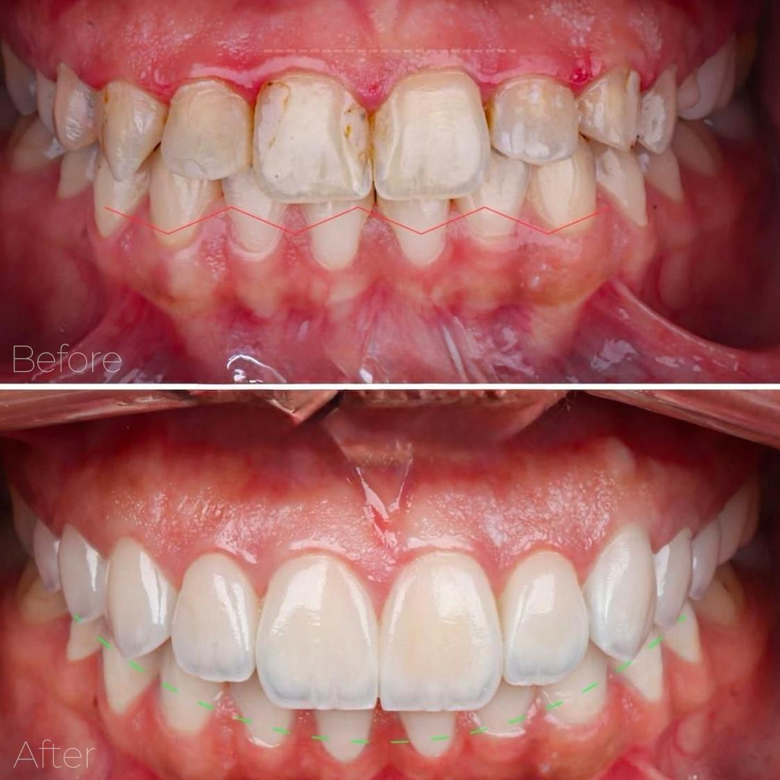 حالة تجميل أسنان 1 - تجميل الاسنان بالفينيرز