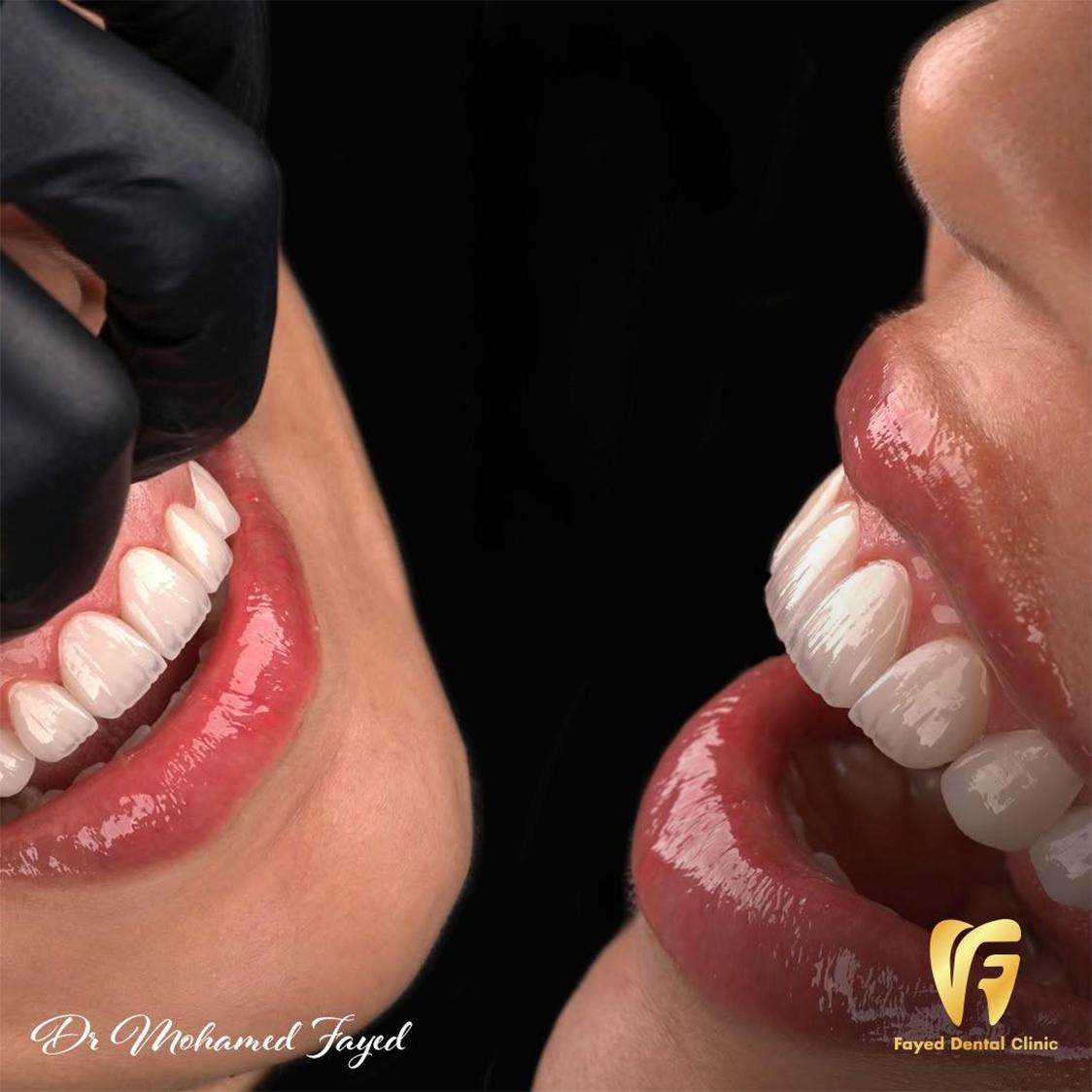 حالة تجميل أسنان 2 - تجميل الاسنان بالفينيرز