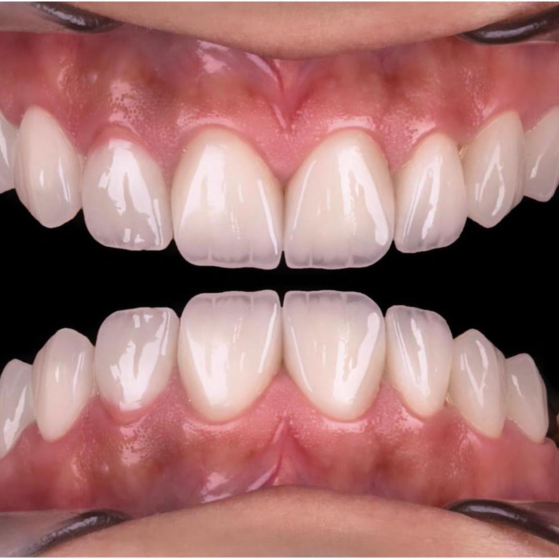 حالة تجميل أسنان 3 - تجميل الاسنان بالفينيرز