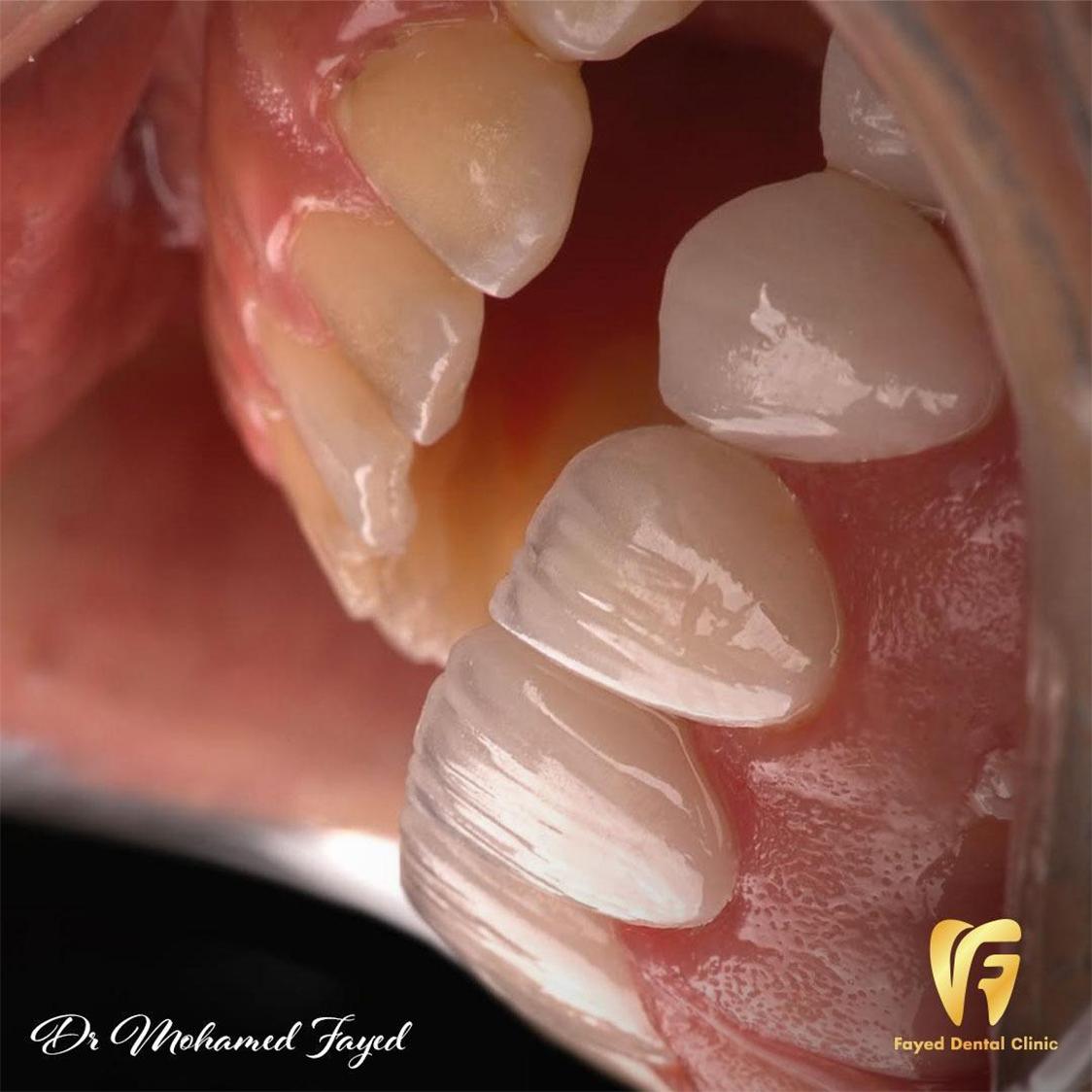 حالة تجميل أسنان 4 - تجميل الاسنان بالفينيرز