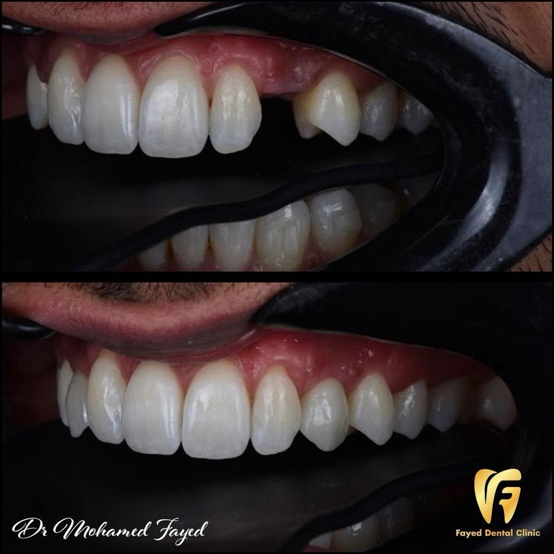 حالة تجميل أسنان 2 - زراعة الأسنان