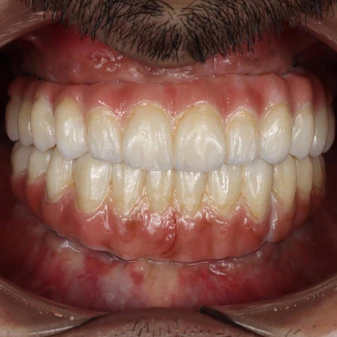 حالة تجميل أسنان 3 - زراعة الأسنان