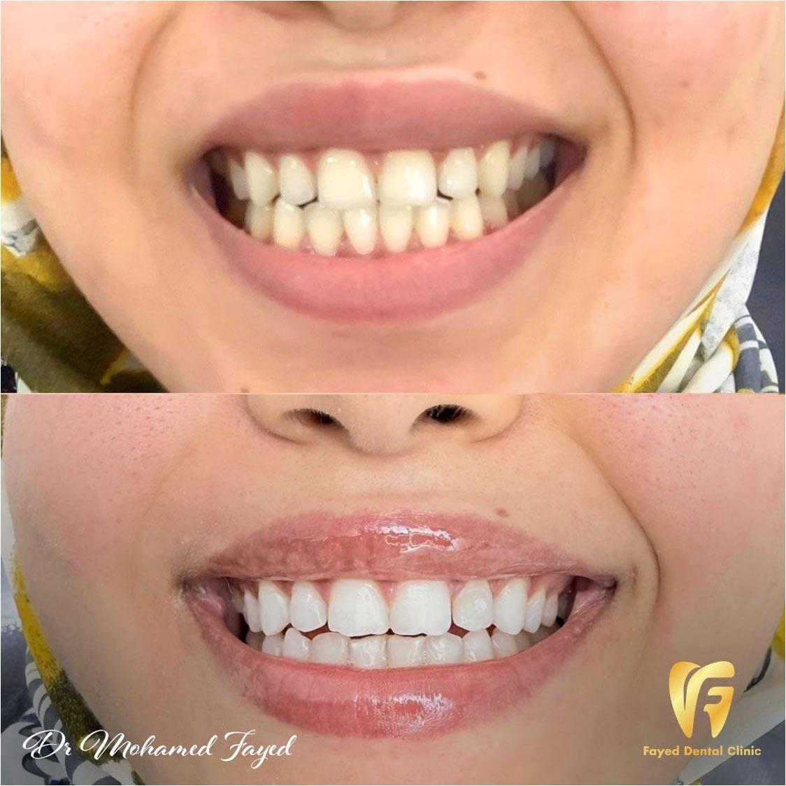 حالة تجميل أسنان - التبييض بالليزر